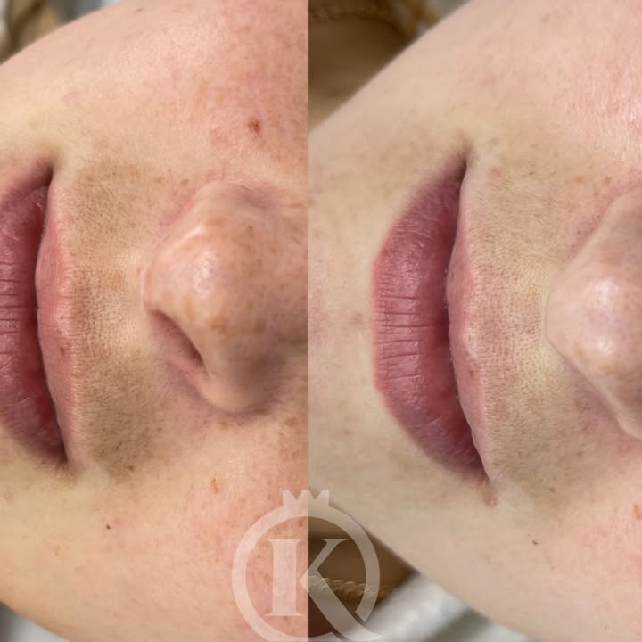 Przebarwienie nad wargą