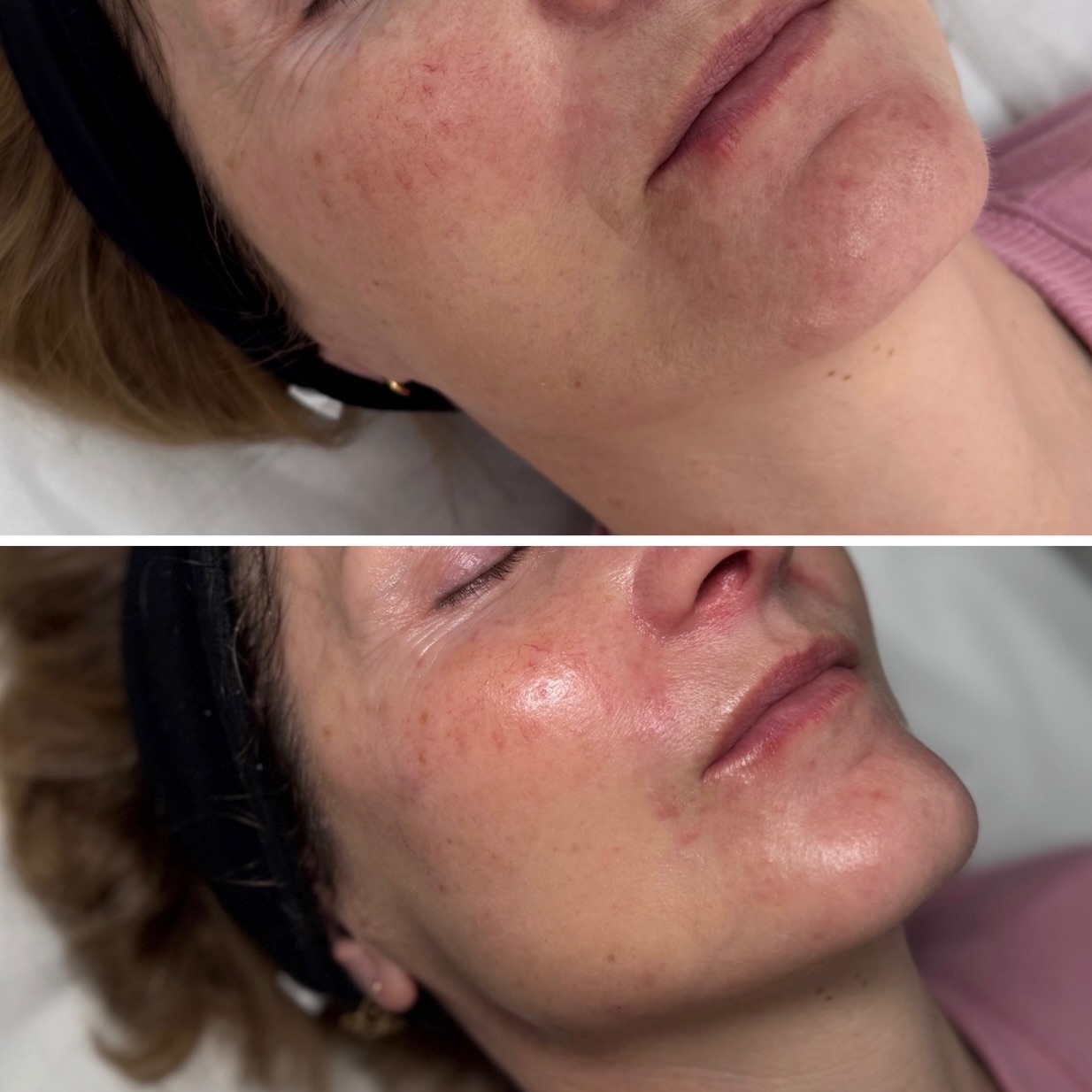 Zdjęcie z Instagrama - Kosmetologia Estetyczna Kinga Brzyzek