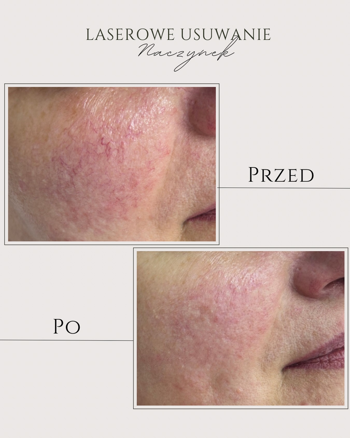 Zdjęcie z Instagrama - Kosmetologia Estetyczna Kinga Brzyzek