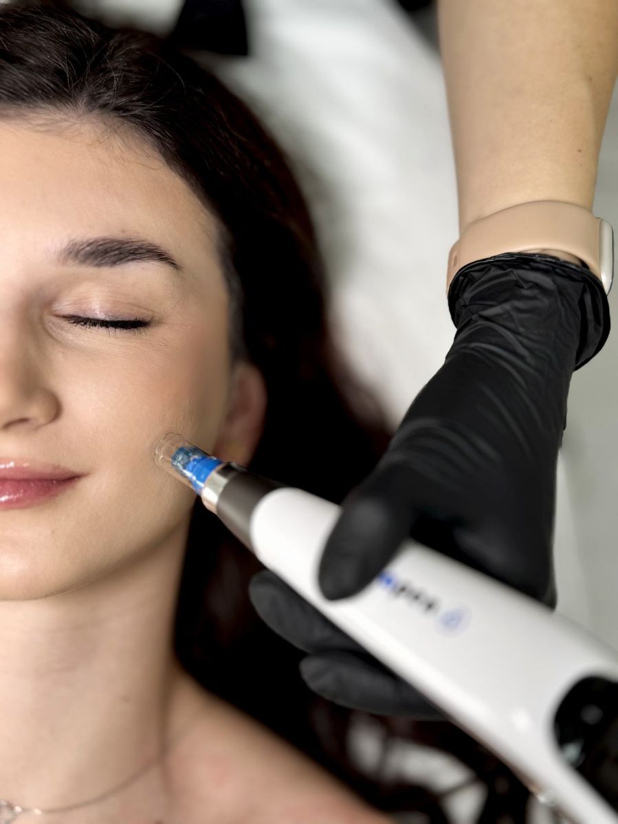 Dermapen 4.0 – na czym polega mezoterapia mikroigłowa skóry?