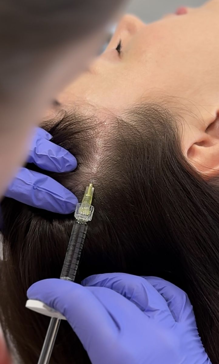 Mezoterapia igłowa skóry głowy - sposób na wzmocnienie włosów i zahamowanie ich wypadaniu