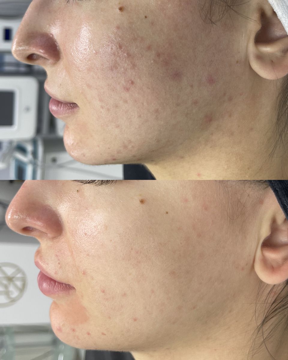 Zabiegi i kosmetyki na trądzik - jak skutecznie walczyć z problemem skóry?