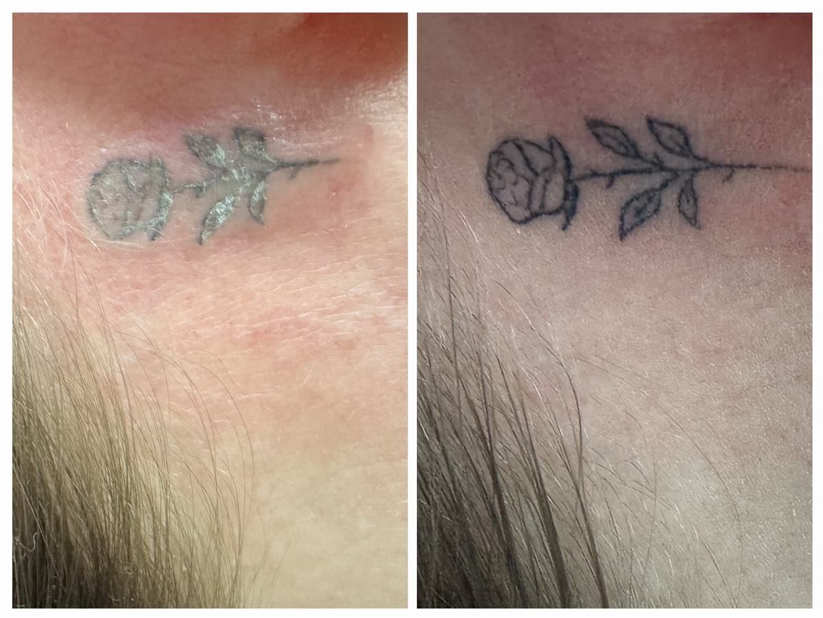 Laserowe usuwanie tatuażu Nowy Targ