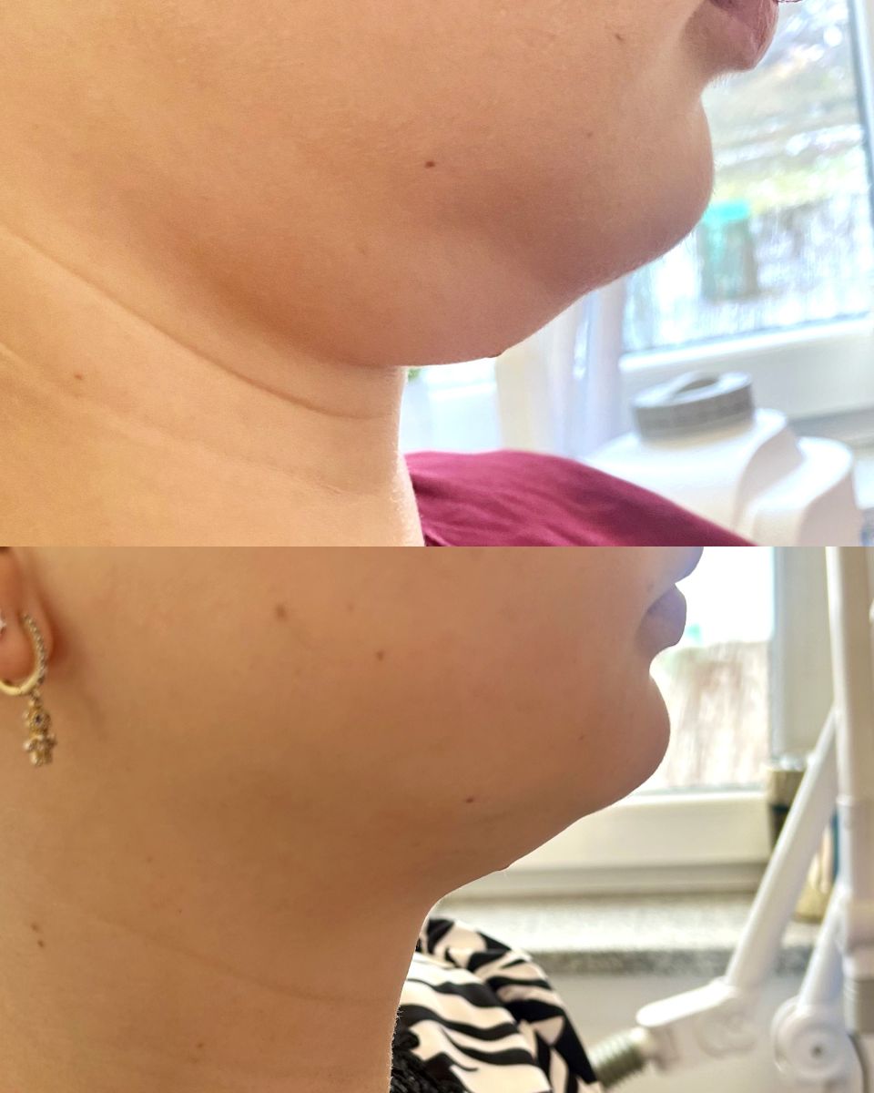 Podwójny podbródek, Twój wróg czy przyjaciel?